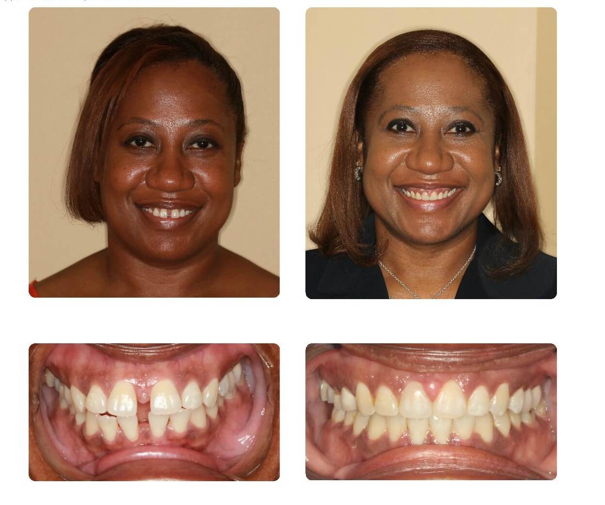 Before And After Adult Braces 55